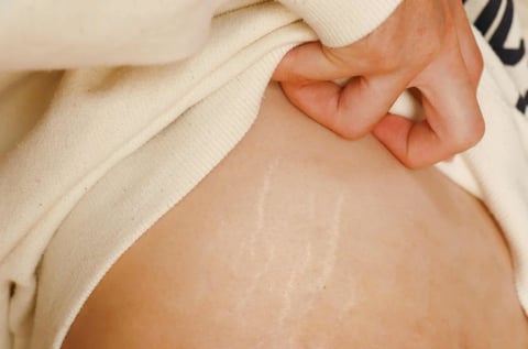 Comprendre et prévenir les vergetures pendant la grossesse